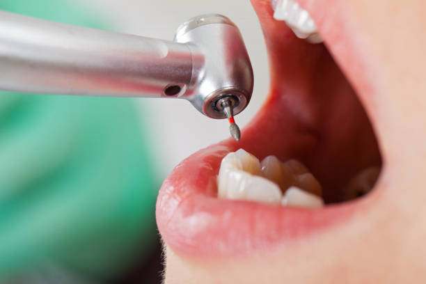 Best Emergency Treatment for Dental Infections or Abscesses in New Rochelle, NY